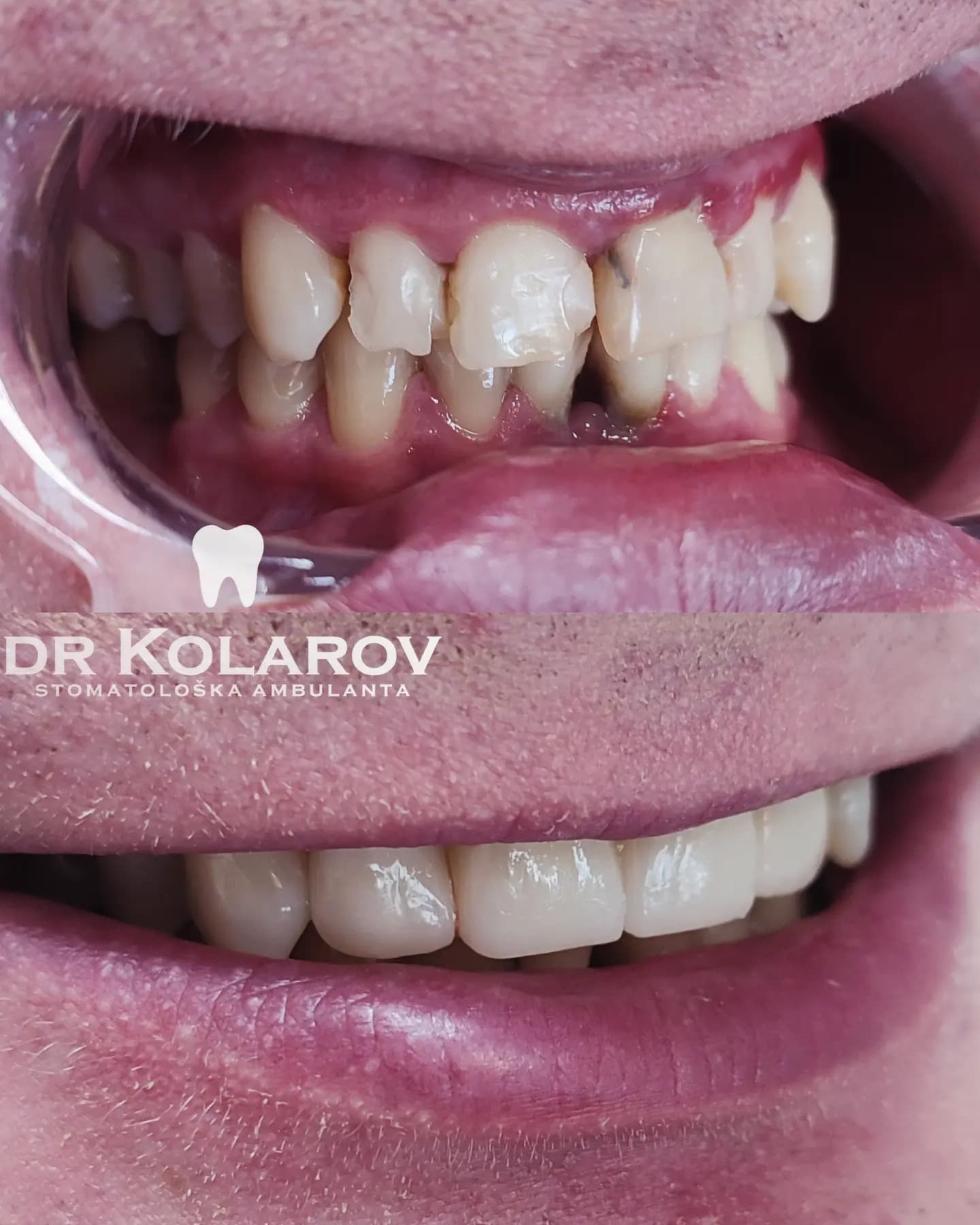 Cirkon-keramičke navlake