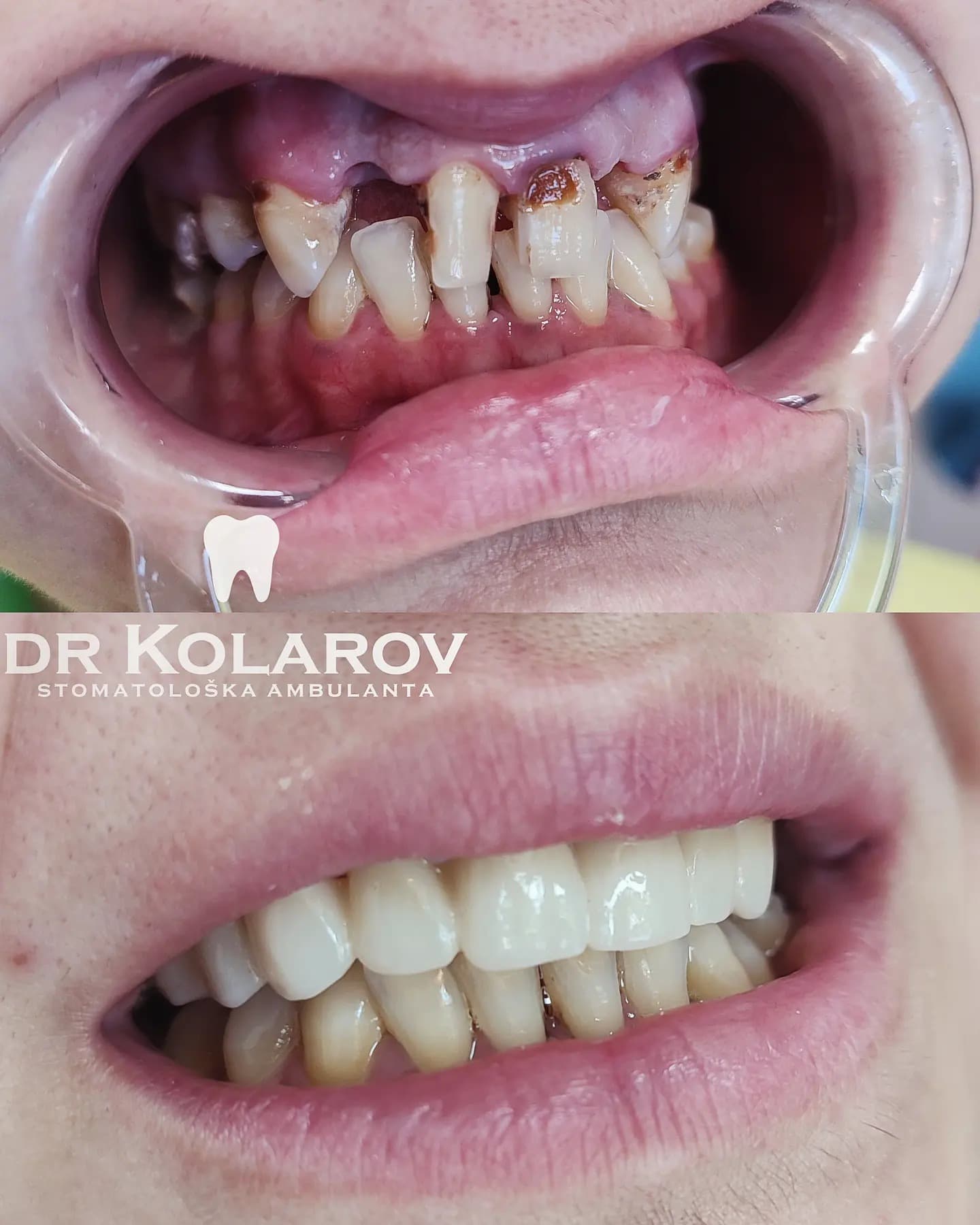 Cirkon-keramičke navlake