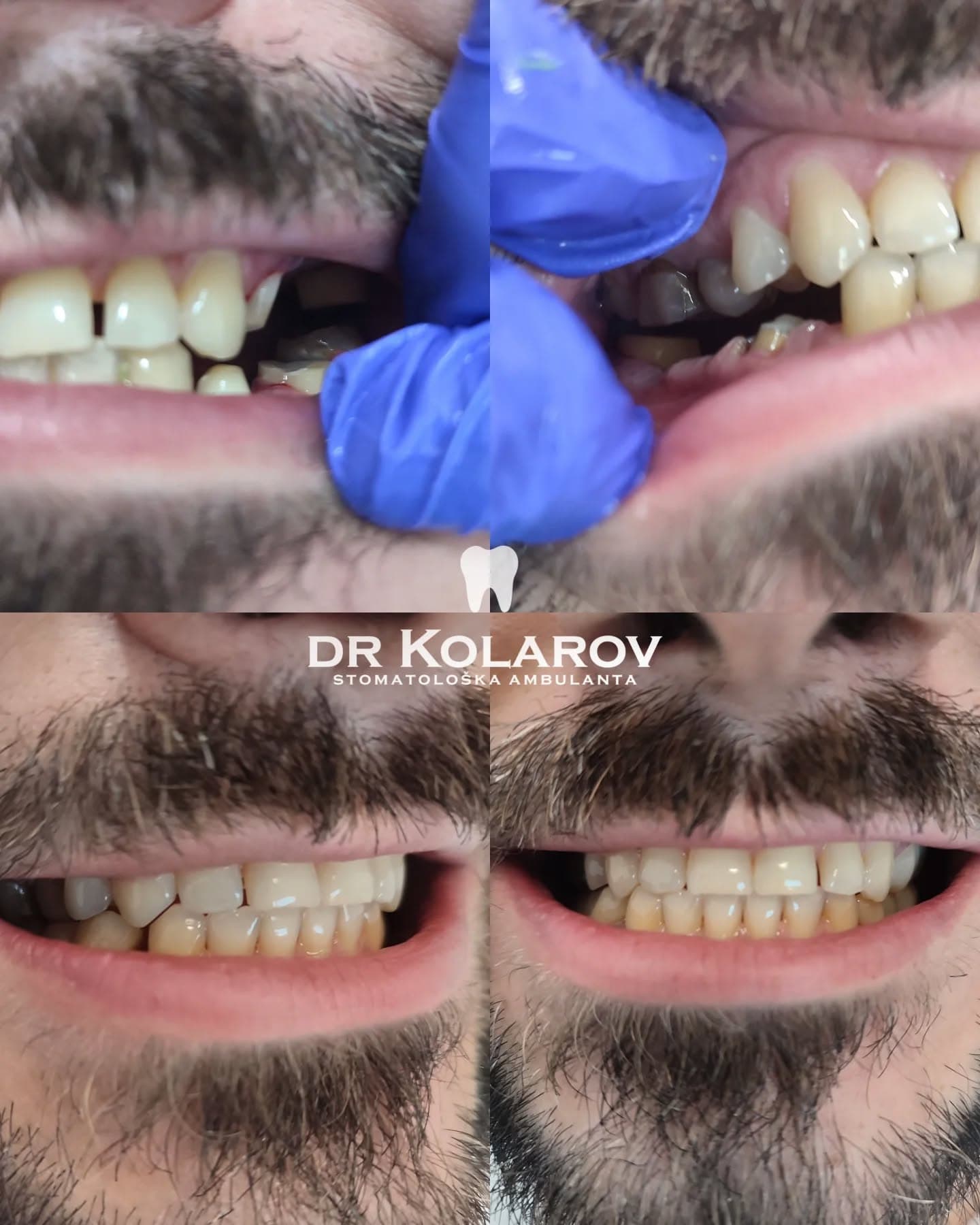 Cirkon-keramičke navlake