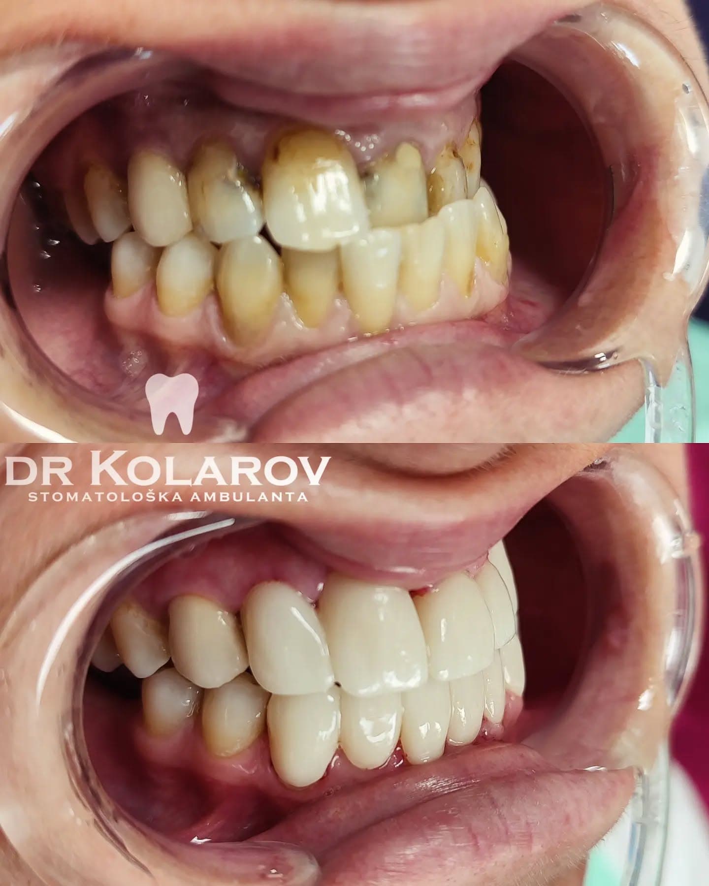 Cirkon-keramičke navlake