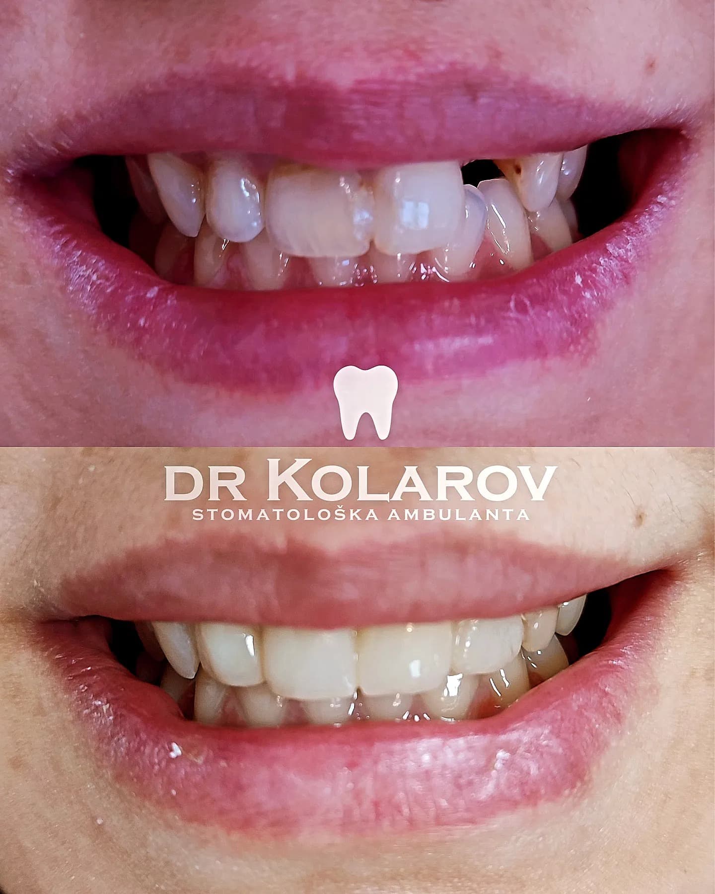 Cirkon-keramički most (gornja vilica)