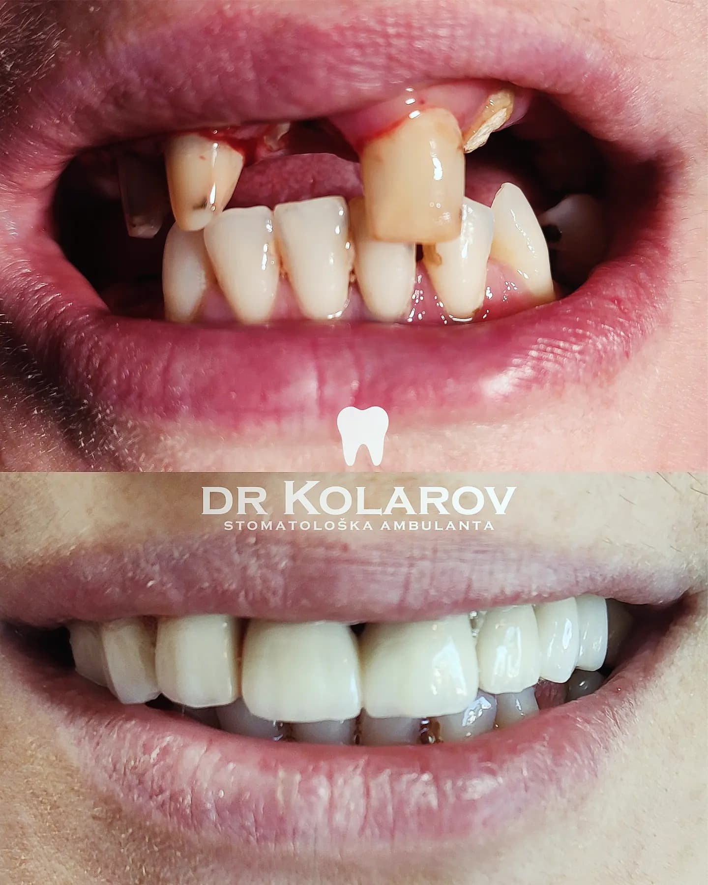 Metal-keramički mostovi